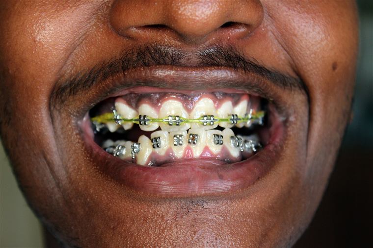 Close-up of a smile with braces
